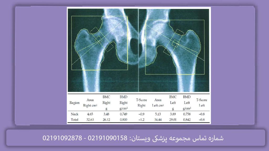 جواب تفسیر تست تراکم استخوان جواب تفسیر تست تراکم استخوان