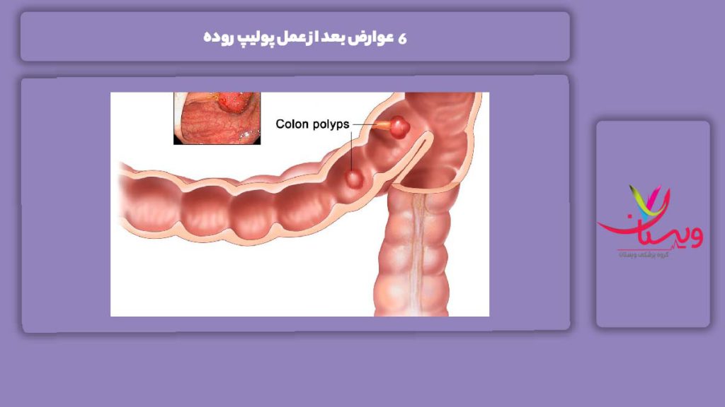 ضررهای عمل پولیپ 6 عوارض بعد از عمل پولیپ روده