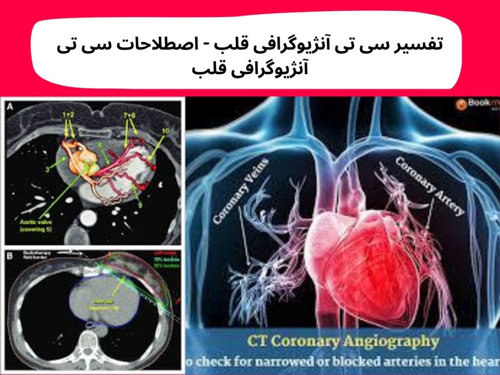 تفسیر سی تی آنژیوگرافی قلب