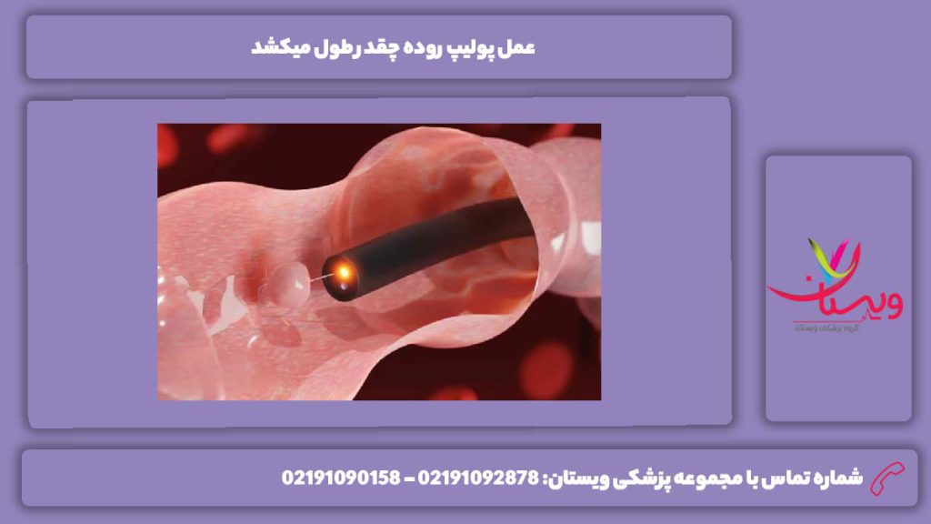 عوامل مؤثر بر مدت زمان انجام این عمل عمل پولیپ روده چقدر طول میکشد