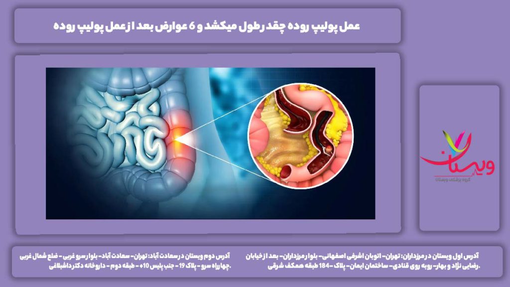 عمل پولیپ روده چقدر طول میکشد
