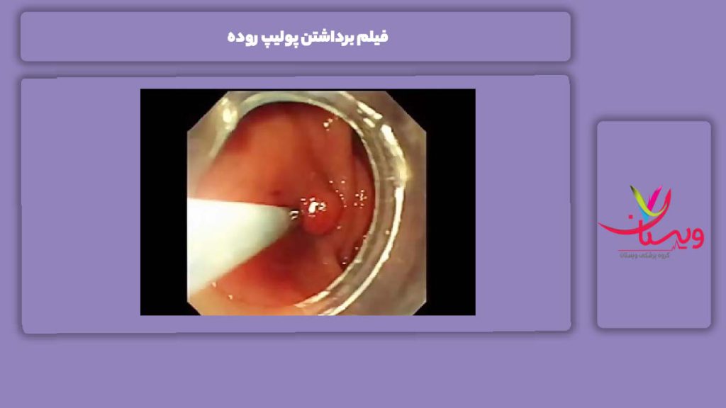 مراحل مشاهده فیلم برداشتن پولیپ روده فیلم برداشتن پولیپ روده