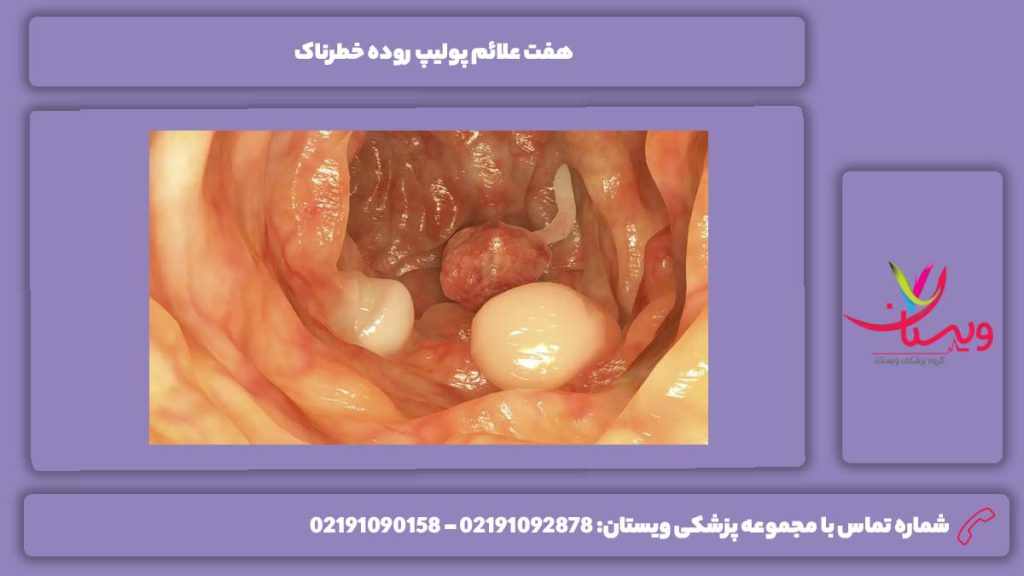 بارزترین نشانهها علائم پولیپ روده خطرناک