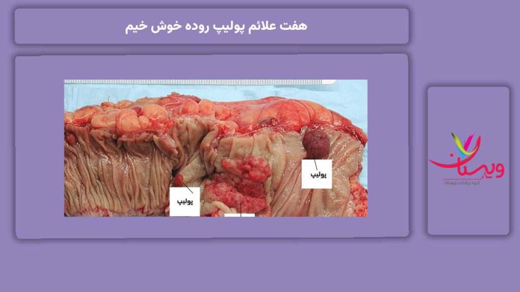 علائم گوارشی خفیف 7علائم پولیپ روده خوش خیم