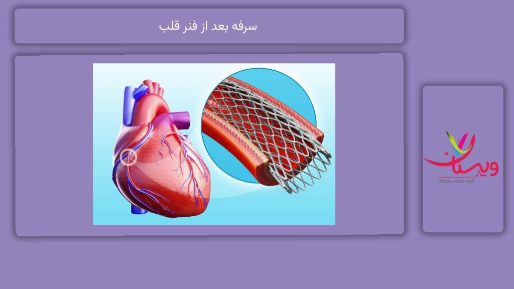 دلایل شایع سرفه سرفه بعد از فنر قلب