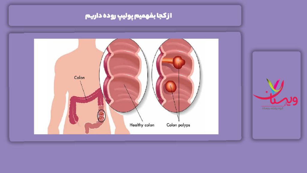 علائم هشداردهنده اولیه از کجا بفهمیم پولیپ روده داریم