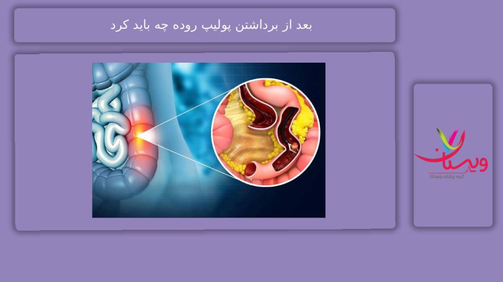 کارهای اضطراری بعد از برداشتن پولیپ بعد از برداشتن پولیپ روده چه باید کرد