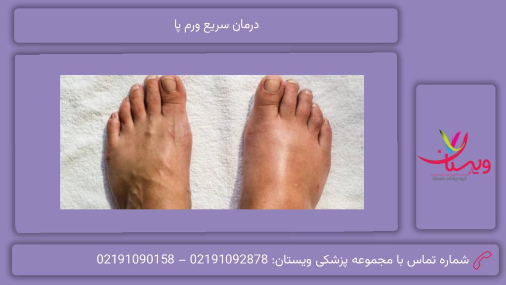 علل رایج ورم پا درمان سریع ورم پا