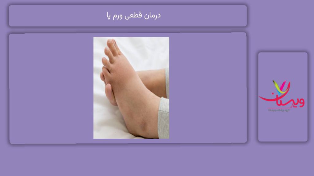راههای درمان ورم پا درمان قطعی ورم پا