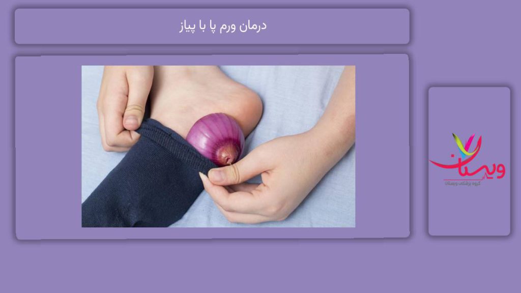 راههای استفاده از پیاز برای ورم پا درمان ورم پا با پیاز