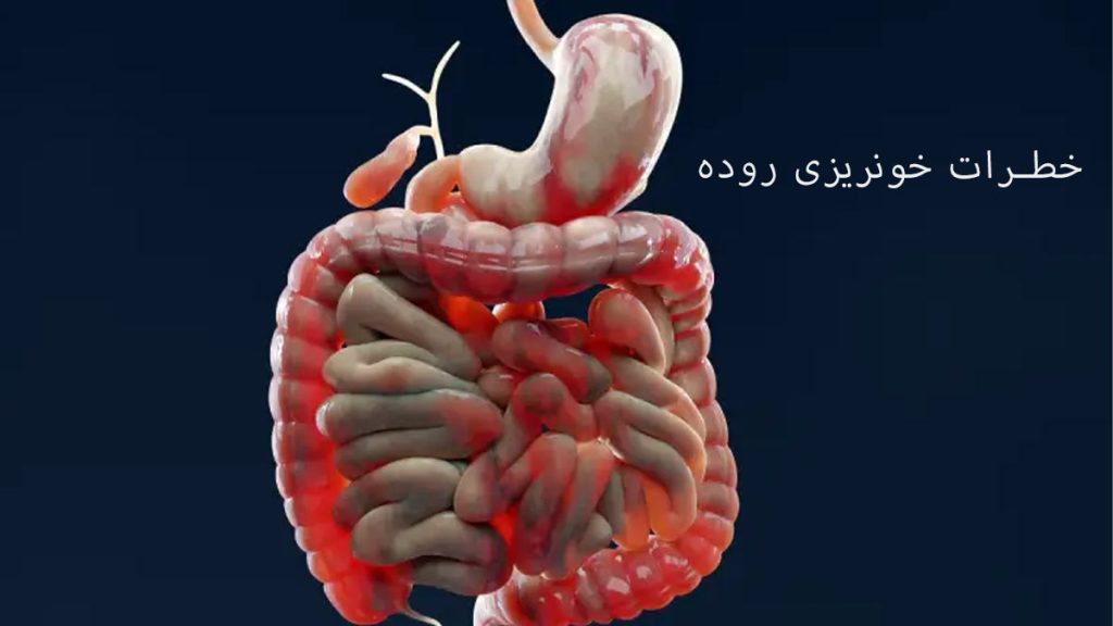 خطرات خونریزی روده آیا خونریزی روده خطرناک است