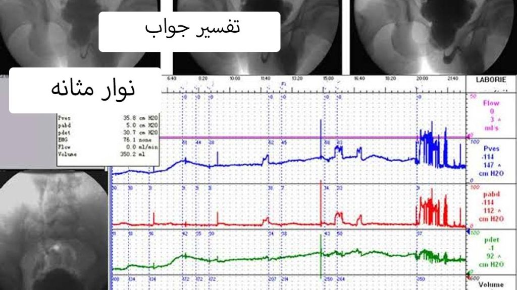 نحوه خواندن و تفسیر تست عملکرد مثانه تفسیر تست یورودینامیک