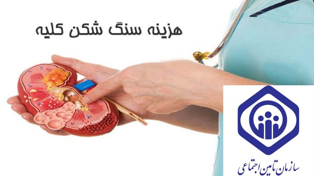 تعرفه مصوب تامین اجتماعی برای درمان سنگ کلیه هزینه سنگ شکن کلیه با بیمه تامین اجتماعی